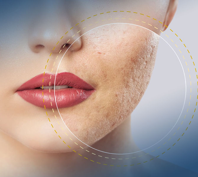 correção de cicatriz de acne em manaus