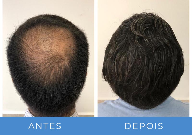 transplante capilar antes e depois fotos