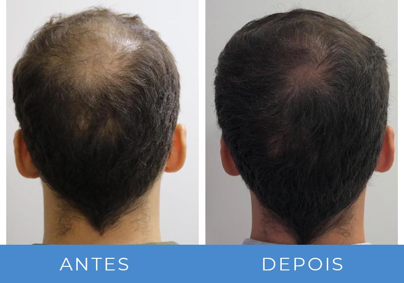 transplante capilar antes e depois fotos