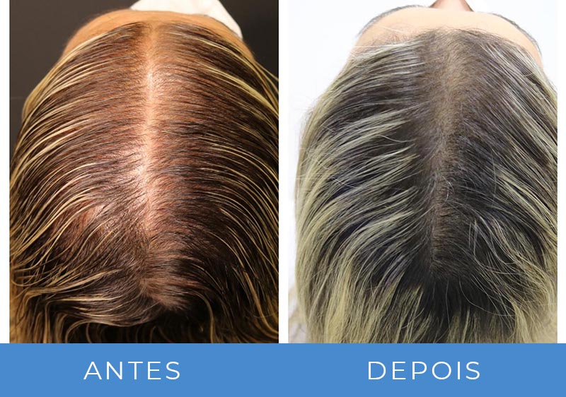 transplante capilar mulher antes e depois fotos