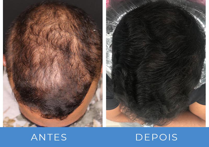transplante capilar antes e depois fotos
