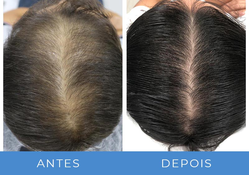 transplante capilar feminino antes e depois fotos