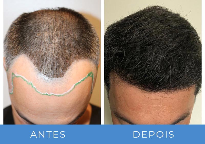 transplante capilar antes e depois fotos