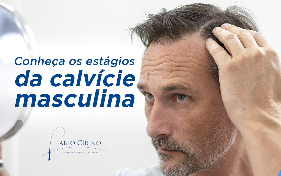 estagios da calvicie masculina