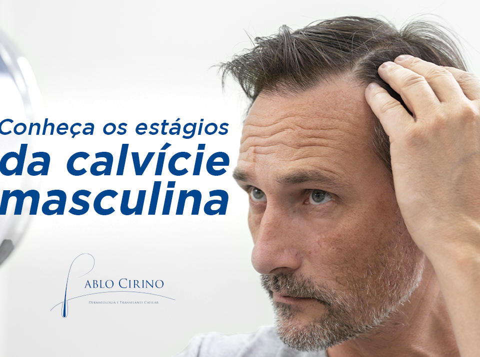 estagios da calvicie masculina